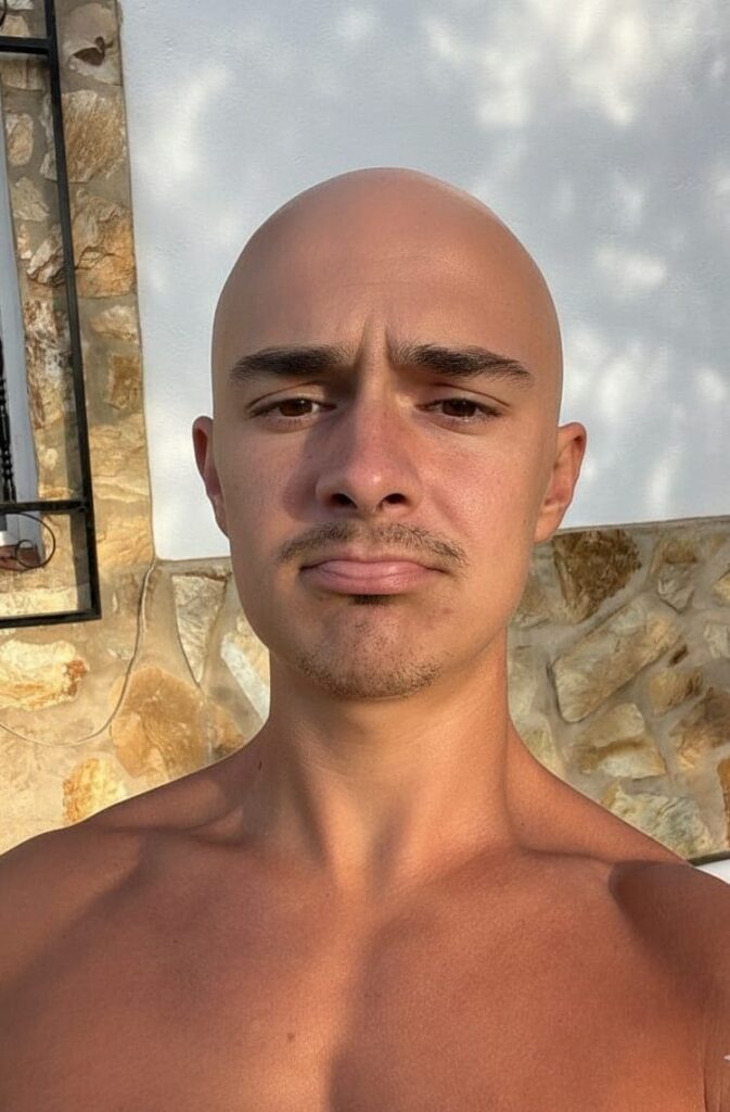 alopecia-caida-del-cabello-salud-capilar